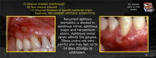 I) Gingival disease (Continued)    B) Non plaque induced	1) Gingival diseases of specific bacterial origin	    Example: RECURRENT APHTOUS STOMATITISFor details click on the booksRecurrent aphtous stomatitis is divided in aphthous minor, aphthous major and herpetiform ulcers. Aphthous minor rarely affects the gingiva. These ulcers are very painful and may last up to 14 days.Etiolgy is unknown.