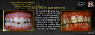  Gingival disease (Continued)    B) Non plaque induced	2) Gingival diseases of viral origin	    a) Herpes virus - PRIMARY HERPETIC GINGIVOSTOMATITISFor details click on the booksTo the left a 13 y.old boy and to the right a 23 y.old man both with primary herpetic gingivostomatitis. Note gingival bleeding and ulcerations which were preceded by vesicles. Also note sero-purulent exudate in the 23 y.old man.