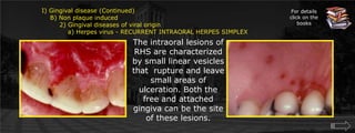  Gingival disease (Continued)    B) Non plaque induced	2) Gingival diseases of viral origin	    a) Herpes virus - RECURRENT INTRAORAL HERPES SIMPLEXFor details click on the booksThe intraoral lesions of RHS are characterized by small linear vesicles that  rupture and leave small areas of ulceration. Both the free and attached gingiva can be the site of these lesions.