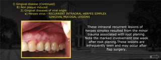 Gingival disease (Continued)    B) Non plaque induced        2) Gingival diseases of viral origin	    a) Herpes virus - RECURRENT INTRAORAL HERPES SIMPLEX 				    GINGIVAL MUCOSAL LESIONSThese intraoral recurrent lesions of herpes simplex resulted from the minor trauma associated with root planing. Note the marked involvement one week after root planing.These lesions are infrequently seen and may occur after    flap surgery. 