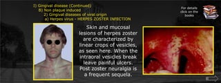 I) Gingival disease (Continued)    B) Non plaque induced        2) Gingival diseases of viral origin	    a) Herpes virus - HERPES ZOSTER INFECTIONFor details click on the booksSkin and mucosal lesions of herpes zoster are characterized by linear crops of vesicles, as seen here. When the intraoral vesicles break leave painful ulcers. Post zoster neuralgia is a frequent sequela.