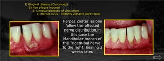 I) Gingival disease (Continued)    B) Non plaque induced        2) Gingival diseases of viral origin	    a) Herpes virus - HERPES ZOSTER INFECTIONHerpes Zoster lesions follow the affected nerve distribution,in this case the Mandibular branch of the Trigeminal nerve. To the right  healing 3 weeks later.