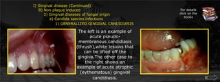  Gingival disease (Continued)    B) Non plaque induced        3) Gingival diseases of fungal origin	    a) Candida species infections		1) GENERALIZED GINGIVAL CANDIDIASISFor details click on the booksThe left is an example of acute pseudo- membranous candidiasis (thrush),white lesions that can be lifted off the gingiva.The other case to the right shows an example of acute atrophic (eythematous) gingival candidiasis.
