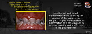For details click on the booksI) Gingival disease (Continued)    B) Non plaque induced        3) Gingival diseases of fungal origin	    b) Linear gingival erythema		HIV ASSOCIATED GINGIVITISNote the well delineated erythematous band following the contour of the free gingival margin. This phenomenon reflects inflammation as a consequence to bacterial invasion and proliferation in the gingival sulcus.