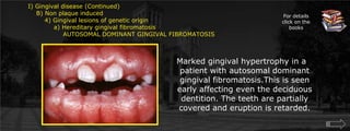  Gingival disease (Continued)    B) Non plaque induced        4) Gingival lesions of genetic origin	    a) Hereditary gingival fibromatosis		AUTOSOMAL DOMINANT GINGIVAL FIBROMATOSISFor details click on the booksMarked gingival hypertrophy in a patient with autosomal dominant gingival fibromatosis.This is seen early affecting even the deciduous dentition. The teeth are partially covered and eruption is retarded.