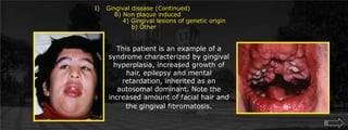 Gingival disease (Continued)    B) Non plaque induced        4) Gingival lesions of genetic origin		 b) Other 		This patient is an example of a syndrome characterized by gingival hyperplasia, increased growth of hair, epilepsy and mental retardation, inherited as an autosomal dominant. Note the increased amount of facial hair and the gingival fibromatosis.