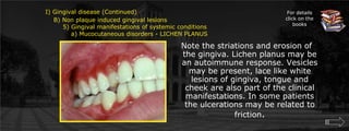 For details click on the booksI) Gingival disease (Continued)	    B) Non plaque induced gingival lesions  		5) Gingival manifestations of systemic conditions		    a) Mucocutaneous disorders - LICHEN PLANUSNote the striations and erosion of the gingiva. Lichen planus may be an autoimmune response. Vesicles may be present, lace like white lesions of gingiva, tongue and cheek are also part of the clinical manifestations. In some patients the ulcerations may be related to friction. 