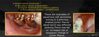 I) Gingival disease (Continued)	    B) Non plaque induced gingival lesions  		5) Gingival manifestations of systemic conditions		    a) Mucocutaneous disorders - LICHEN PLANUSThese are examples of squamous cell carcinoma arising in a previous erosive Lichen Planus observed in two different patients.There may be an increased risk of neoplastic change in Lichen Planus.