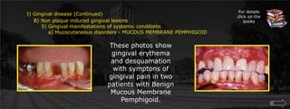 I) Gingival disease (Continued)	    B) Non plaque induced gingival lesions  		5) Gingival manifestations of systemic conditions		    a) Mucocutaneous disorders - MUCOUS MEMBRANE PEMPHIGOIDFor details click on the booksThese photos show gingival erythema and desquamation with symptons of gingival pain in two patients with Benign Mucous Membrane Pemphigoid.