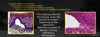 I) Gingival disease (Continued)    B) Non plaque induced gingival lesions  	5) Gingival manifestations of systemic conditions	    a) Mucocutaneous disorders - MUCOUS MEMBRANE PEMPHIGOIDThe drawing and the microscopy show the  vesicle formation beginning at the Basement Membrane typical of Benign Mucous Membrane Pemphigoid.