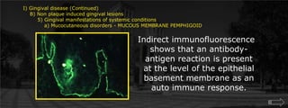 I) Gingival disease (Continued)    B) Non plaque induced gingival lesions  	5) Gingival manifestations of systemic conditions	    a) Mucocutaneous disorders - MUCOUS MEMBRANE PEMPHIGOIDIndirect immunofluorescence shows that an antibody-antigen reaction is present at the level of the epithelial basement membrane as an auto immune response.