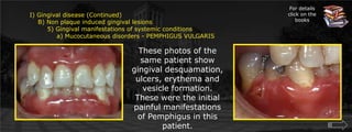 For details click on the booksI) Gingival disease (Continued)    B) Non plaque induced gingival lesions  	5) Gingival manifestations of systemic conditions             a) Mucocutaneous disorders - PEMPHIGUS VULGARISThese photos of the same patient show gingival desquamation, ulcers, erythema and vesicle formation. These were the initial painful manifestations of Pemphigus in this patient. 