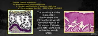 I) Gingival disease (Continued)    B) Non plaque induced gingival lesions  	5) Gingival manifestations of systemic conditions             a) Mucocutaneous disorders - PEMPHIGUS VULGARISThe drawing and the microscopy demonstrate the intraepithelial vesicle formation typical of Pemphigus Vulgaris. Also note Tzank cells within the vesicle lumen.