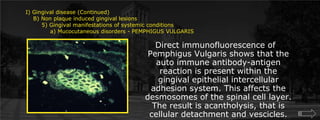 I) Gingival disease (Continued)    B) Non plaque induced gingival lesions  	5) Gingival manifestations of systemic conditions             a) Mucocutaneous disorders - PEMPHIGUS VULGARISDirect immunofluorescence of Pemphigus Vulgaris shows that the auto immune antibody-antigen reaction is present within the gingival epithelial intercellular adhesion system. This affects the desmosomes of the spinal cell layer. The result is acantholysis, that is cellular detachment and vescicles. 