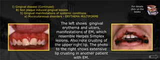 I) Gingival disease (Continued)    B) Non plaque induced gingival lesions  	5) Gingival manifestations of systemic conditions             a) Mucocutaneous disorders - ERYTHEMA MULTIFORMEFor details click on the books The left shows  gingival erythema and ulcers, manifestations of EM, which resemble Herpes Simplex lesions. Also note crusting of the upper right lip. The photo to the right shows extensive lip crusting in another patient with EM. 