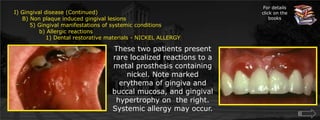 For details click on the books Gingival disease (Continued)    B) Non plaque induced gingival lesions  	5) Gingival manifestations of systemic conditions             b) Allergic reactions			1) Dental restorative materials - NICKEL ALLERGYThese two patients present rare localized reactions to a metal prosthesis containing nickel. Note marked erythema of gingiva and buccal mucosa, and gingival hypertrophy on  the right. Systemic allergy may occur.    