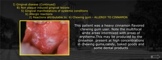 I) Gingival disease (Continued)    B) Non plaque induced gingival lesions  	5) Gingival manifestations of systemic conditions             b) Allergic reactions		2) Reactions attributable to: b) Chewing gum - ALLERGY TO CINNAMONThis patient was a heavy cinnamon flavored chewing gum user. Note the multifocal white areas intermixed with areas of erythema.This may be produced by the cinnamon  present at high concentrations in chewing gums,candy, baked goods and some dental products