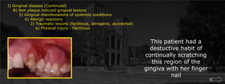  Gingival disease (Continued)    B) Non plaque induced gingival lesions  	5) Gingival manifestations of systemic conditions             b) Allergic reactions		3) Traumatic lesions (factitious, iatrogenic, accidental)		    a) Physical injury - FactitiousThis patient had a destuctive habit of continually scratching this region of the gingiva with her finger nail