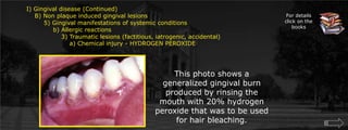  Gingival disease (Continued)    B) Non plaque induced gingival lesions  	5) Gingival manifestations of systemic conditions             b) Allergic reactions		3) Traumatic lesions (factitious, iatrogenic, accidental)		    a) Chemical injury - HYDROGEN PEROXIDEFor details click on the booksThis photo shows a generalized gingival burn produced by rinsing the mouth with 20% hydrogen peroxide that was to be used for hair bleaching. 