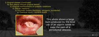  Gingival disease (Continued)    B) Non plaque induced gingival lesions  	5) Gingival manifestations of systemic conditions             b) Allergic reactions		3) Traumatic lesions (factitious, iatrogenic, accidental)		    a) Chemical injury - ASPIRIN BURNThis photo shows a large burn produced by the local use of an aspirin tablet to ease the pain of a periodontal abscess.