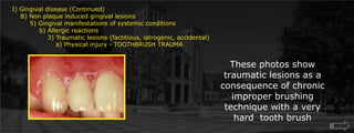  Gingival disease (Continued)    B) Non plaque induced gingival lesions  	5) Gingival manifestations of systemic conditions             b) Allergic reactions		3) Traumatic lesions (factitious, iatrogenic, accidental)		    a) Physical injury - TOOTHBRUSH TRAUMAThese photos show traumatic lesions as a consequence of chronic improper brushing technique with a very hard  tooth brush