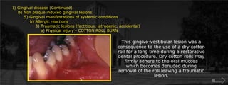 I) Gingival disease (Continued)    B) Non plaque induced gingival lesions  	5) Gingival manifestations of systemic conditions             b) Allergic reactions		3) Traumatic lesions (factitious, iatrogenic, accidental)		    a) Physical injury - COTTON ROLL BURNThis gingivo-vestibular lesion was a consequence to the use of a dry cotton roll for a long time during a restorative dental procedure. Dry cotton rolls may firmly adhere to the oral mucosa which becomes denuded during removal of the roll leaving a traumatic lesion.