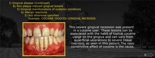 I) Gingival disease (Continued)    B) Non plaque induced gingival lesions  	5) Gingival manifestations of systemic conditions             b) Allergic reactions		5) Not otherwise specified		    Example: COCAINE INDUCED GINGIVAL NECROSISThis severe gingival recession was present in a cocaine user. These lesions can be associated with the habit of topical cocaine usage on the gingiva and can vary from superficial ulcerations to severe tissue necrosis, as seen in this patient.The vaso constrictive effect of cocaine is the cause.
