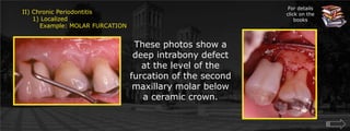 For details click on the booksII) Chronic Periodontitis     1) Localized	Example: MOLAR FURCATIONThese photos show a deep intrabony defect at the level of the furcation of the second maxillary molar below a ceramic crown.
