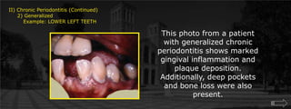 II) Chronic Periodontitis (Continued)     2) Generalized	Example: LOWER LEFT TEETHThis photo from a patient with generalized chronic periodontitis shows marked gingival inflammation and plaque deposition. Additionally, deep pockets and bone loss were also present.