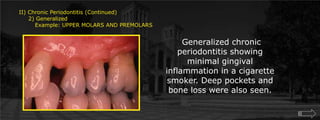 II) Chronic Periodontitis (Continued)     2) Generalized	Example: UPPER MOLARS AND PREMOLARS Generalized chronic periodontitis showing minimal gingival inflammation in a cigarette smoker. Deep pockets and bone loss were also seen.