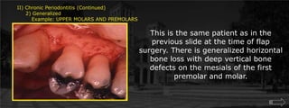 II) Chronic Periodontitis (Continued)     2) Generalized	Example: UPPER MOLARS AND PREMOLARSThis is the same patient as in the previous slide at the time of flap surgery. There is generalized horizontal bone loss with deep vertical bone defects on the mesials of the first premolar and molar. 