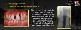 For details click on the booksIII) Aggressive Periodontitis      A) Localized	 Example: JUVENILE ONSET PERIODONTITISThe clinical photo and the X-Ray of this 28 year-old man show the advanced alveolar bone loss in the absence of significant gingival inflammation, typical of the localized aggressive periodontitis.