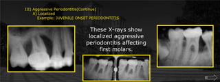 III) Aggressive Periodontitis(Continue)      A) Localized	 Example: JUVENILE ONSET PERIODONTITISThese X-rays show localized aggressive periodontitis affecting first molars.