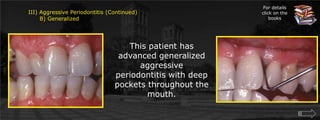 For details click on the booksIII) Aggressive Periodontitis (Continued)      B) GeneralizedThis patient has advanced generalized aggressive periodontitis with deep pockets throughout the mouth.