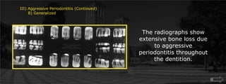 III) Aggressive Periodontitis (Continued)      B) GeneralizedThe radiographs show extensive bone loss due to aggressive periodontitis throughout the dentition.