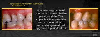 III) Aggressive Periodontitis (Continued)      B) GeneralizedPosterior segments of the patient shown in the previous slide. The upper left first premolar was extracted due to extensive generalized aggressive periodontitis.