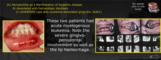 For details click on the booksIV) Periodontitis as a Manifestation of Systemic Disease      A) Associated with hematologic disorders	 2) LEUKEMIAS (see also Leukemia associated gingivitis, IA2b1)These two patients had acute myelogenous leukemia. Note the severe gingivo-periodontal involvement as well as the lip hemorrhage.
