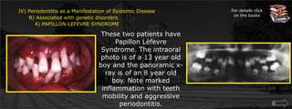 IV) Periodontitis as a Manifestation of Systemic Disease      B) Associated with genetic disorders	 4) PAPILLON-LEFEVRE SYNDROMEFor details click on the booksThese two patients have Papillon Lèfevre Syndrome. The intraoral photo is of a 13 year old boy and the panoramic x-ray is of an 8 year old boy. Note marked inflammation with teeth mobility and aggressive periodontitis.