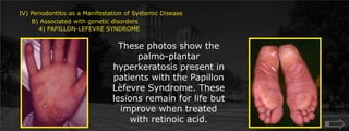 IV) Periodontitis as a Manifestation of Systemic Disease      B) Associated with genetic disorders	 4) PAPILLON-LEFEVRE SYNDROMEThese photos show the palmo-plantar hyperkeratosis present in patients with the Papillon Lèfevre Syndrome. These lesions remain for life but improve when treated with retinoic acid. 