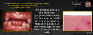 For details click on the booksIV) Periodontitis as a Manifestation of Systemic Disease      B) Associated with genetic disorders	 11) HYPOPHOSPHATASIAThe intraoral photo is of a child with hypophosphatasia who lost his anterior teeth for lack of cementum formation as seen in the microscopy of the root of one of the lost teeth.