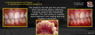 V) Necrotizing Periodontal Disease     A) NECROTIZING ULCERATIVE GINGIVITISFor details click on the booksThe photo to the left and the one below show necrotizing lesions affecting marginal gingiva and interdental papillae. The right photo is 3 weeks post-treatment with scaling and oral hygiene instruction.
