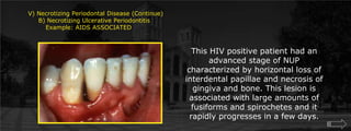 V) Necrotizing Periodontal Disease (Continue)     B) Necrotizing Ulcerative Periodontitis	Example: AIDS ASSOCIATEDThis HIV positive patient had an advanced stage of NUP characterized by horizontal loss of interdental papillae and necrosis of gingiva and bone. This lesion is associated with large amounts of fusiforms and spirochetes and it rapidly progresses in a few days.