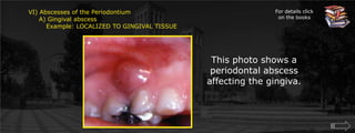 VI) Abscesses of the Periodontium     A) Gingival abscess	Example: LOCALIZED TO GINGIVAL TISSUEFor details click on the booksThis photo shows a periodontal abscess affecting the gingiva.