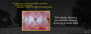VI) Abscesses of the Periodontium (Continue)     B) Periodontal abscess	Example: SPREAD TO INVOLVE LARGER AREAThis photo shows a periodontal abscess involving a large area.