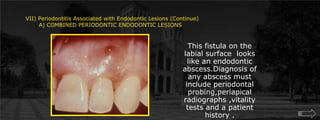 VII) Periodontitis Associated with Endodontic Lesions (Continue)       A) COMBINED PERIODONTIC ENDODONTIC LESIONS	This fistula on the labial surface  looks like an endodontic abscess.Diagnosis of any abscess must include periodontal probing,periapical radiographs ,vitality tests and a patient history . 