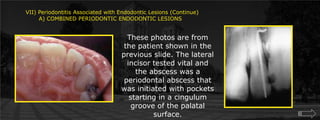 VII) Periodontitis Associated with Endodontic Lesions (Continue)       A) COMBINED PERIODONTIC ENDODONTIC LESIONSThese photos are from the patient shown in the previous slide. The lateral incisor tested vital and the abscess was a periodontal abscess that was initiated with pockets starting in a cingulum groove of the palatal surface.