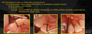 VIII) Developed or Acquired Deformities and Conditions        A) Localized tooth related factors that modify or predispose to plaque induced	    gingival disease, periodontitis	    1) Anatomic factorsExample: DEVELOPMENT AT GROOVE ON PALATAL OF UPPER LATERAL INCISOR, RESULTING IN			      PERIODONTAL BONE LOSS.