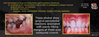 VIII) Developed or Acquired Deformities and Conditions (Continue)        A) Localized tooth related factors that modify or predispose to plaque induced	    gingival disease, periodontitis	    2) Dental restorationsExample: OVER CONTOURED CROWNS. POORLY FITTING MARGINSFor details click on the booksThese photos show gingivo-periodontal reactions associated with poorly fitting margins of these over contoured crowns.