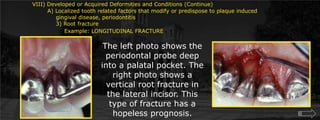 VIII) Developed or Acquired Deformities and Conditions (Continue)        A) Localized tooth related factors that modify or predispose to plaque induced	    gingival disease, periodontitis	    3) Root fractureExample: LONGITUDINAL FRACTUREThe left photo shows the periodontal probe deep into a palatal pocket. The right photo shows a vertical root fracture in the lateral incisor. This type of fracture has a hopeless prognosis.