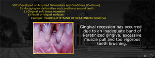 VIII) Developed or Acquired Deformities and Conditions (Continue)        B) Mucogingival deformities and conditions around teeth	    1) Gingival soft tissue recession	    	a) Facial or lingual surfacesExample: INADEQUATE BAND OF KERATINIZED GINGIVAGingival recession has occurred due to an inadequate band of keratinized gingiva, excessive muscle pull and too vigorous tooth brushing.